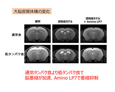骨脳 神経疾患患者の脳形態の特徴｜Super Human | 理学療法士／保健学博士 Ph.D.